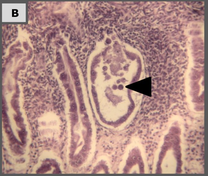 Fig. 4B: Control positivo (4 dpi): Redondeo y descamación de las células del epitelio del hepatopáncreas debidos a toxina de V. parahaemolyticus (punta de flecha) en un túbulo necrotizante, rodeado de espesa encapsulación hemocítica. 