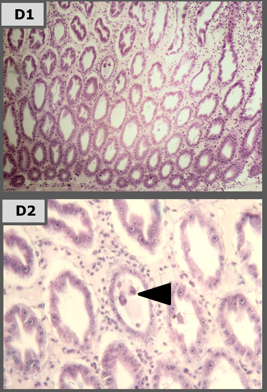 Fig. 4D: Sanolife PRO-2 (10 dpi): se observó redondeo y descamación de las células del epitelio del hepatopáncreas en forma esporádica (punta de flecha D2). La altura del epitelio se redujo respecto al NC, pero la pérdida de la diferenciación celular tipo era menos pronunciada (principalmente menos células B). La infiltración hemocítica era menos profusa, con el espacio intersticial pareciendo más fibroso. 