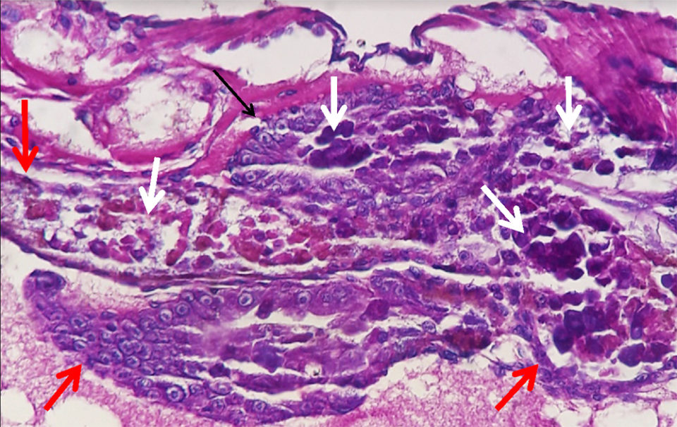 Fig. 2: Hepatopancreas (HP), moribund PL (acute AHPND). HP tubules are visible (red arrows) and clusters of sloughed, HP epithelial cells (thick arrows) are evident in the lumen of the tubules. No bacteria (cells or colonies) or inflammation (hemocyte infiltration/melanized tissue zones) are in the section. H&amp;E, 400X.